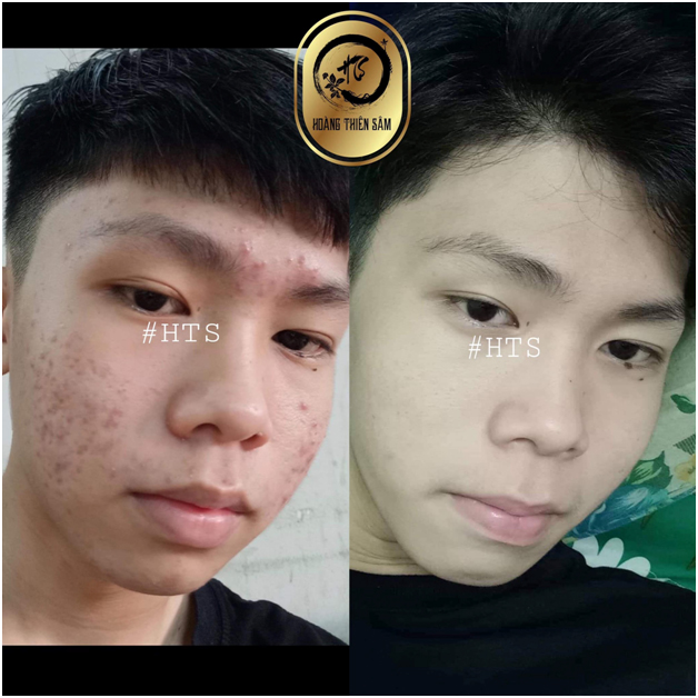 [HCM]Combo Tái Tạo Siêu Cấp Tốc Hoàng Thiên Sâm