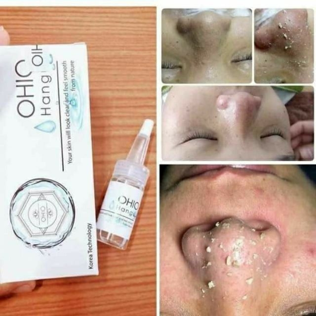 Ủ Mụn Cám Mụn Đầu Đen Hàn Quốc