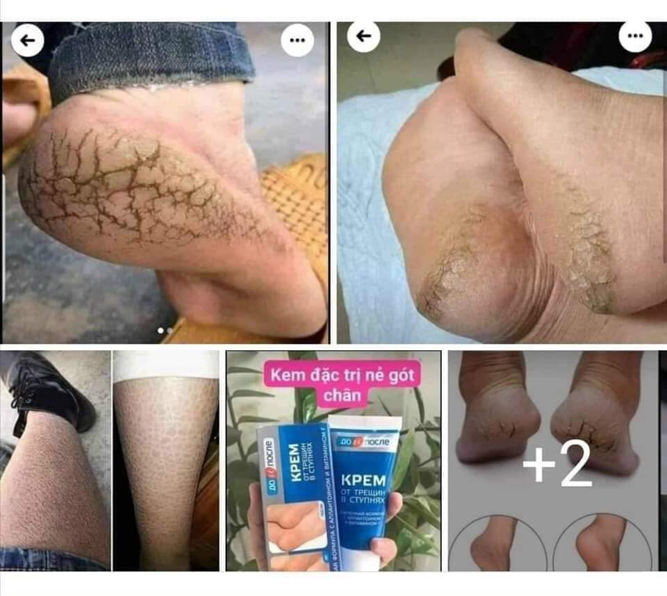 Kem nứt gót chân Kpem Apteka Nga
