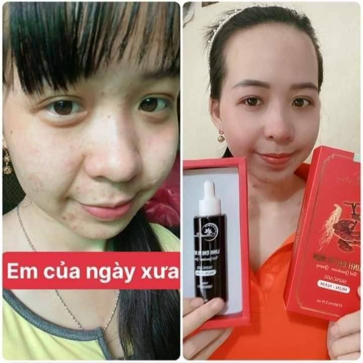 Linh chi vi mụn