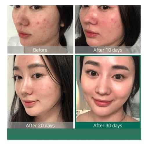 Serum The Ordinary Aha 30% + Bha 2%