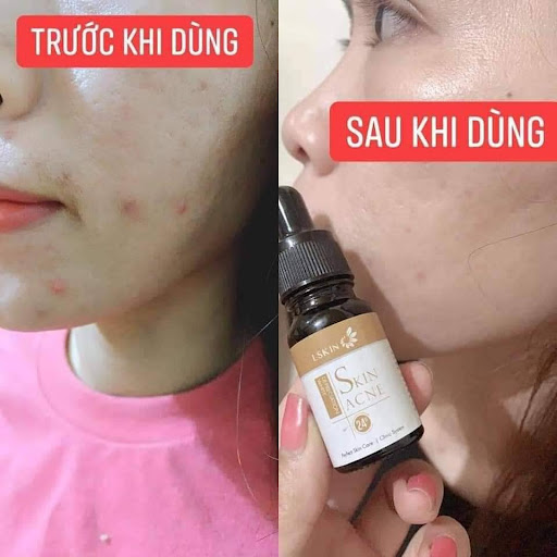 Cốt mụn Bạch Sen Lskin Đan Thy - sản phẩm chính hãng