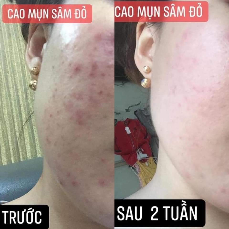 Combo Cao Mụn Sâm Đỏ + Sữa rửa mặt Nhân Sâm - sạch mụn sáng da