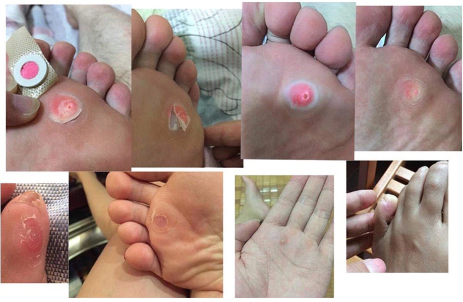 MỤN CÓC MIẾNG DÁN CORN REMOVAL PLASTER (Hộp 6 miếng)