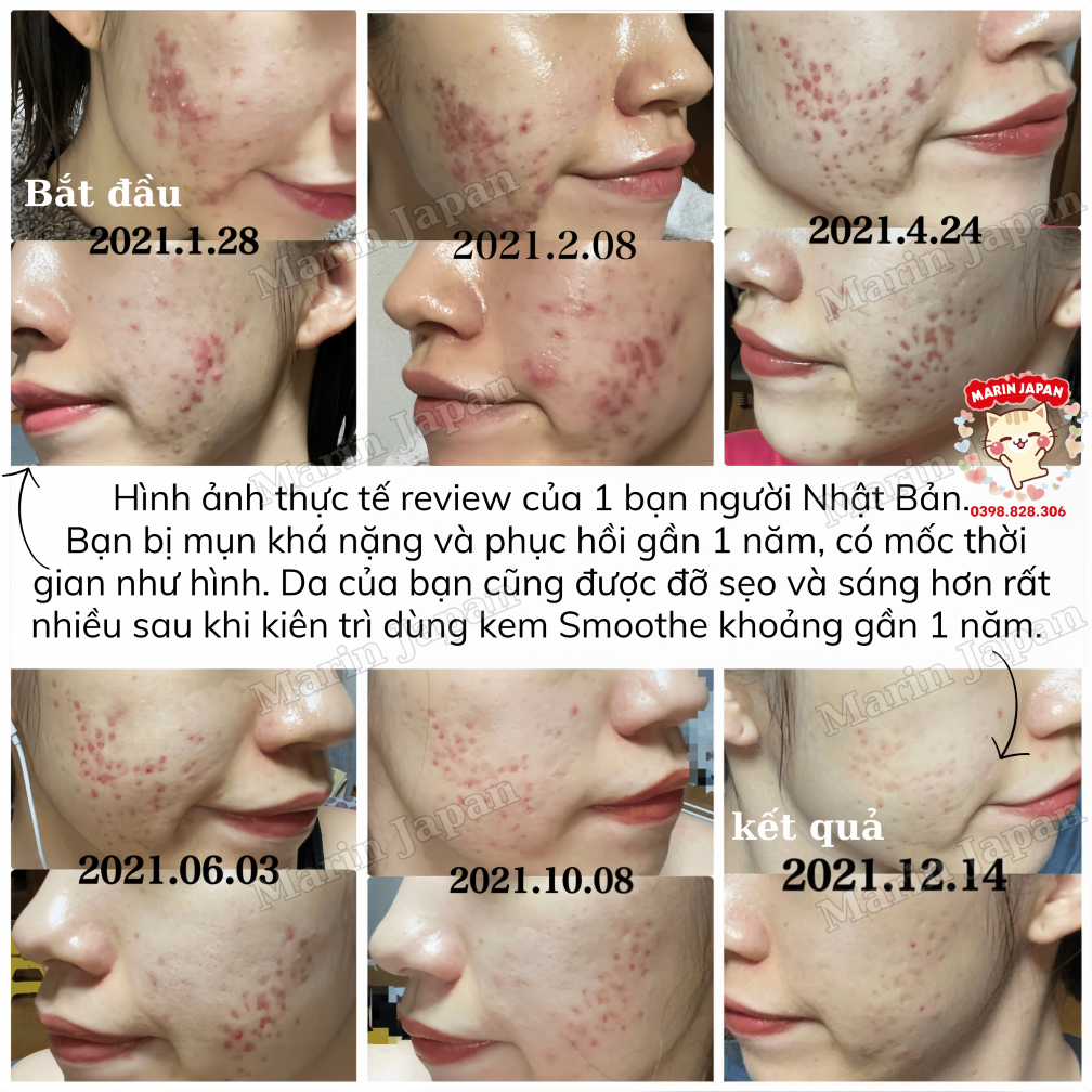 (Hàng Nhật,có bill store) kem thâm sẹo, thâm mụn Smoothe Nhật Bản