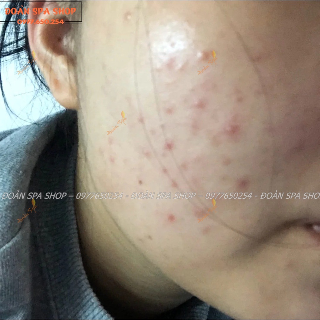 Vi sinh mụn hạt DevaCell - Vi sinh mụn Deva Cell