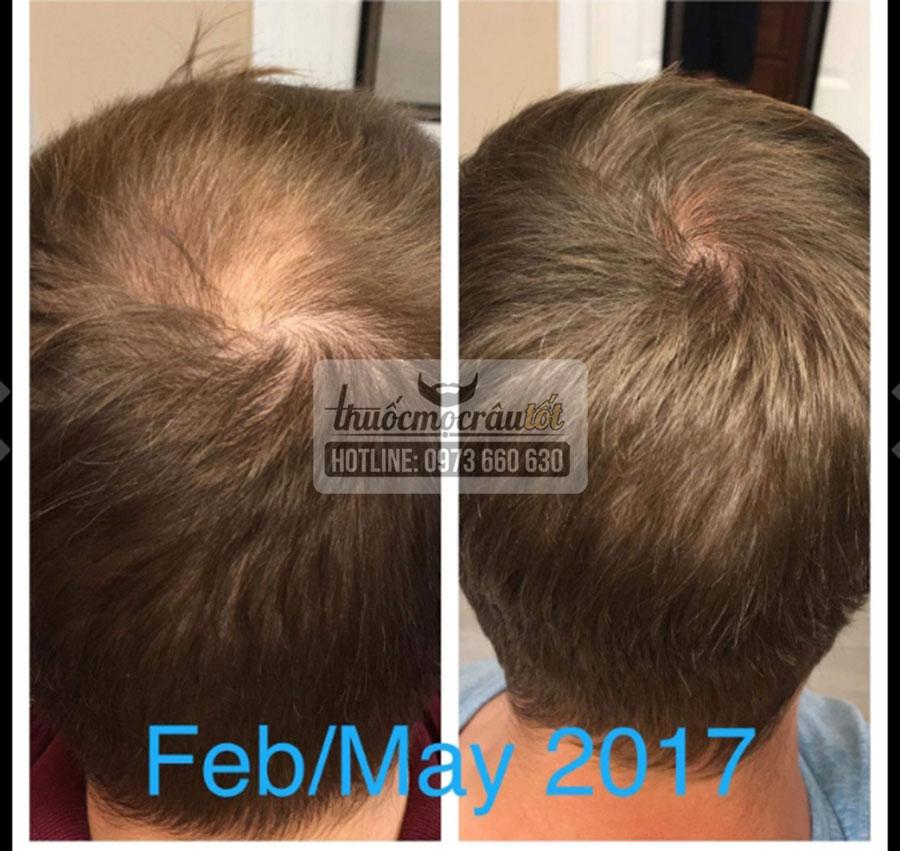 [HCM]Minoxidil 5% mọc Râu Tóc Mỹ hãng Kirkland tặng bột LCLT
