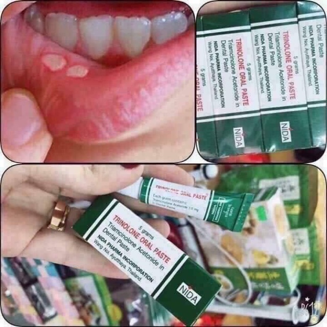 Kem Bôi Nhiệt Miệng Trinolone Oral Paste Thái Lan 5gr