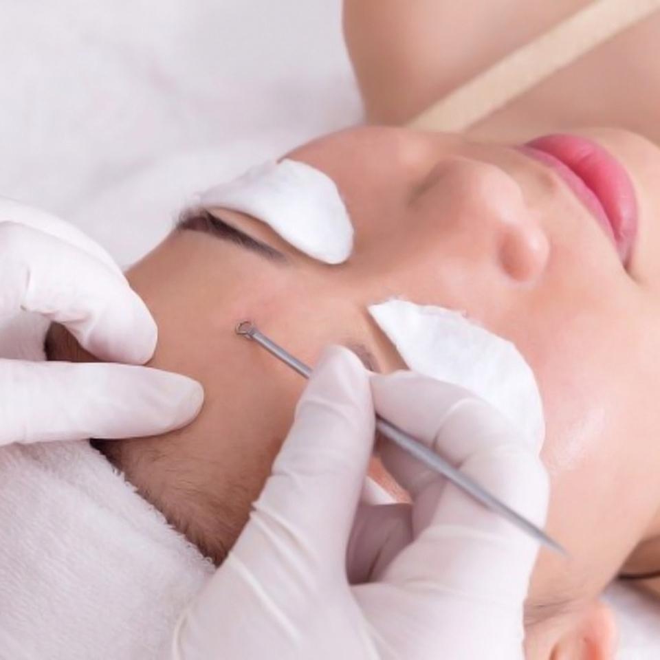 Bộ 4 cây lấy mụn rất an toàn 8 đầu