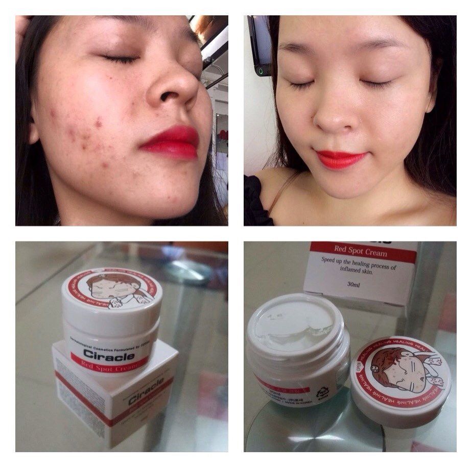 Kem Mụn Ciracle Red Spot Healing Cream 30ml