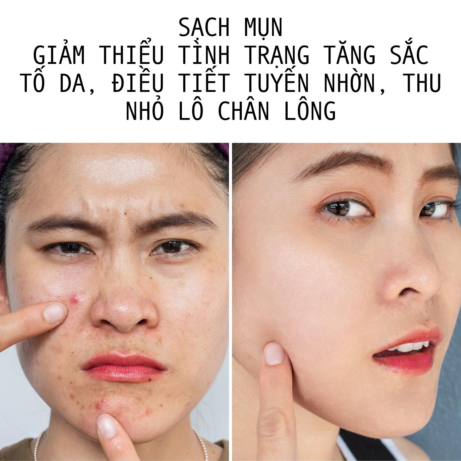 Bộ Giảm Mụn Mờ Thâm Doctor Care Dành Cho Da Dầu( serum giảm mụn +kem giảm mụn Acnes Elimination Cream )