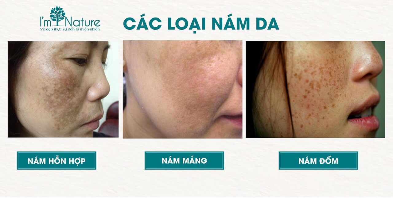 Bộ sản phẩm Nám I’m Nature