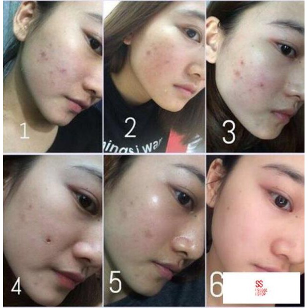 Kem làm giảm mụn Shiseido pimplit Nhật Bản