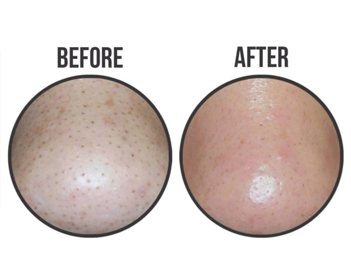 Hộp 20 miếng dán lột mụn Good Bye BlackHead Ciracle