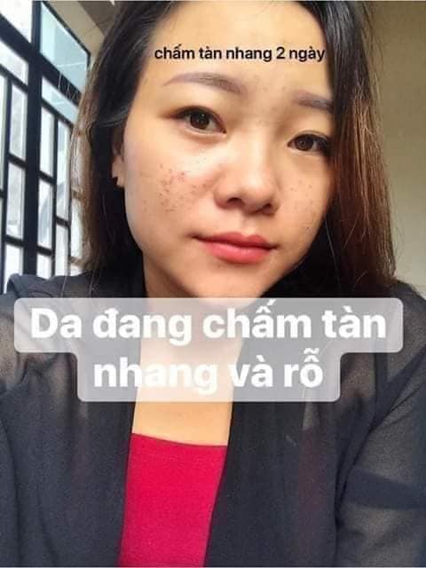 Chấm tàn nhang Yody White Phương Anh