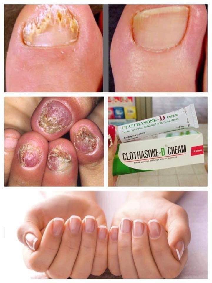 Kem Bôi Nấm Móng Tay Chân CLOTHASONE-D Thái Lan