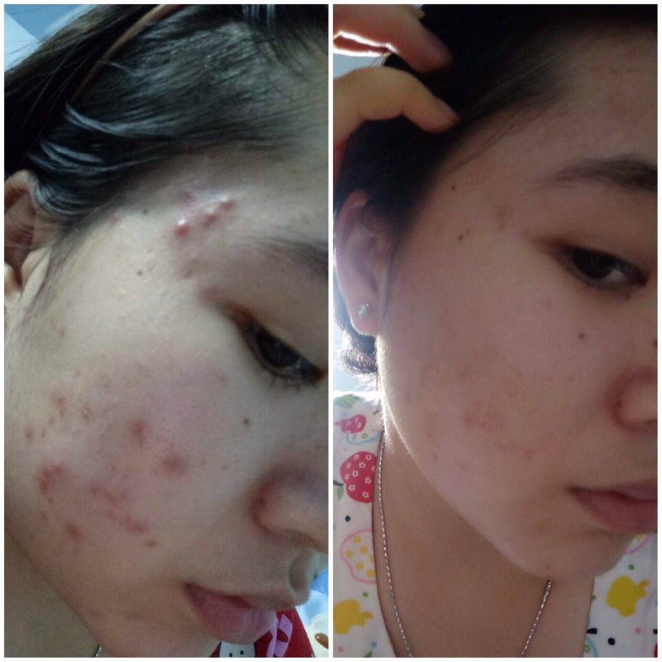 Chấm mụn siêu tốc Linh Sâm 12 lọ