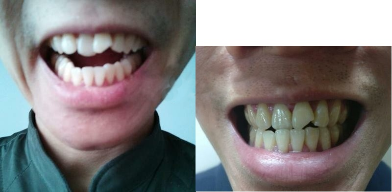 Bộ Niềng Răng Tại Nhà - Orthodontic Alignment Trainer Kit