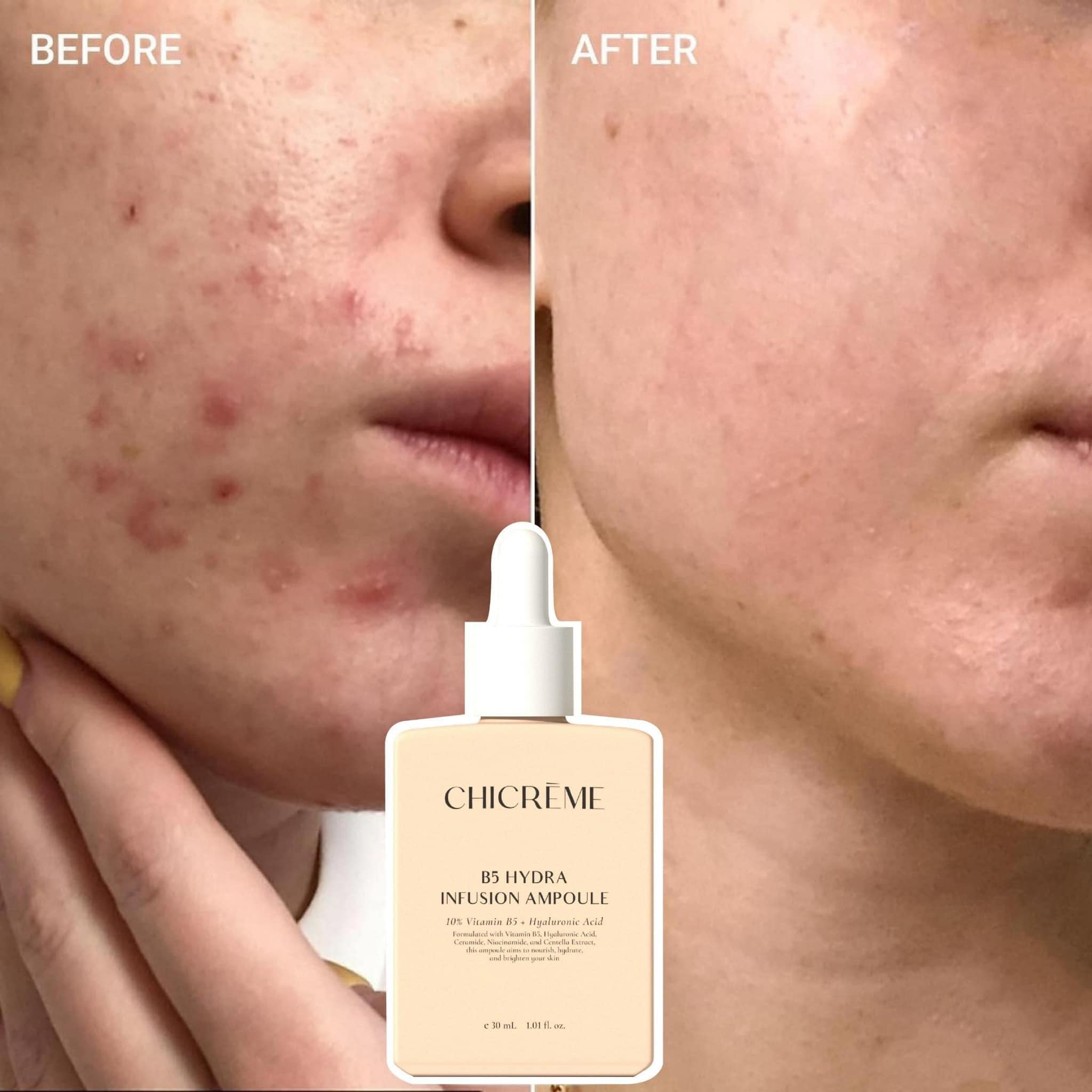 Serum Phục Hồi Da Chicreme B5 Hydra Infusion Ampoule 30ml