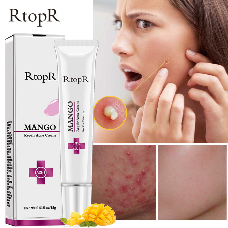 RtopR Sửa chữa xoài Kem Trị Mụn Chống mụn trứng cá trị mụn sẹo Kem trị mụn đầu đen thu nhỏ lỗ chân lông làm trắng da mặt chăm sóc da Mango Repair Acne Cream giá rẻ