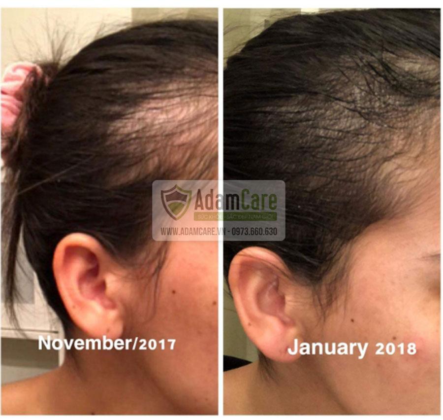 [HCM]Bột Retinol pha Minoxidil