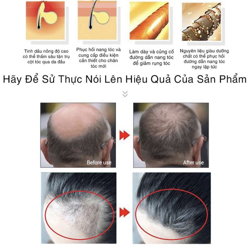[HCM]Tinh chất ngăn ngừa rụng tóc kích mọc tóc nhanh chóng
