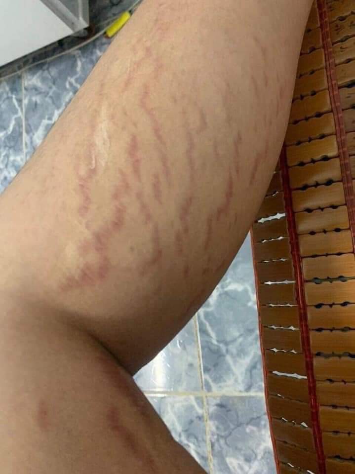 [100% CHÍNH HÃNG ] Kem Rạn Da Multi 16 - Làm Mờ Rạn Da Sau Sinh Và Rạn Da Do Tăng Cân (20g)