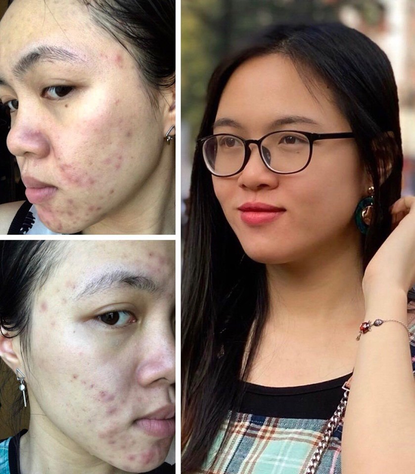 [HCM]SERUM OGANA TRỊ MỤN