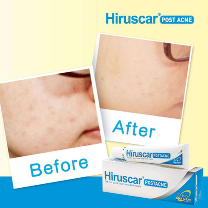 [HCM]Hiruscar Post Acne gel 5g - Cải Thiện Mờ Sẹo - cvspharmacy