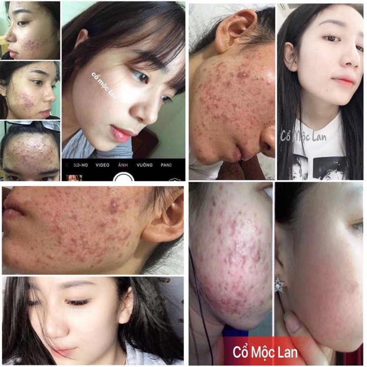 [HCM]Renew skin Dr T Cổ Mộc Lan