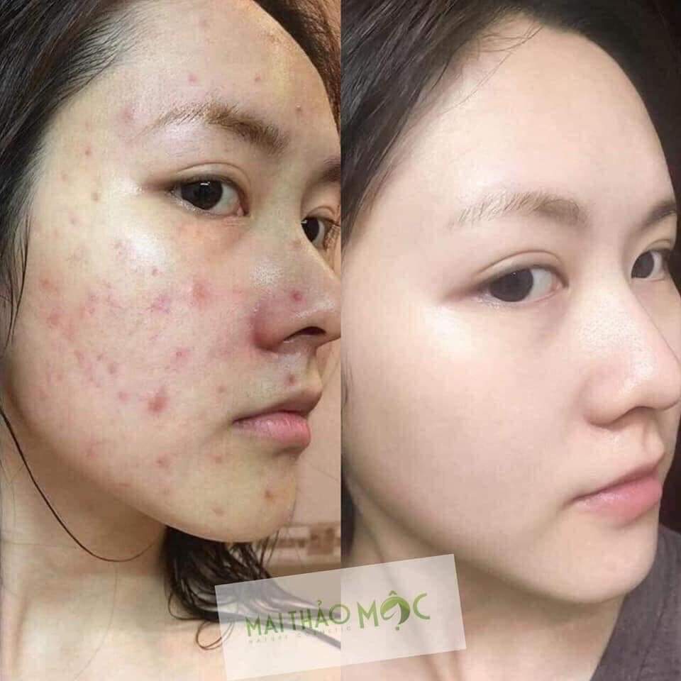 TÁI TẠO CAO CẤP YODY TOMORROW GENTLE PEEL MẪU MỚI 2026