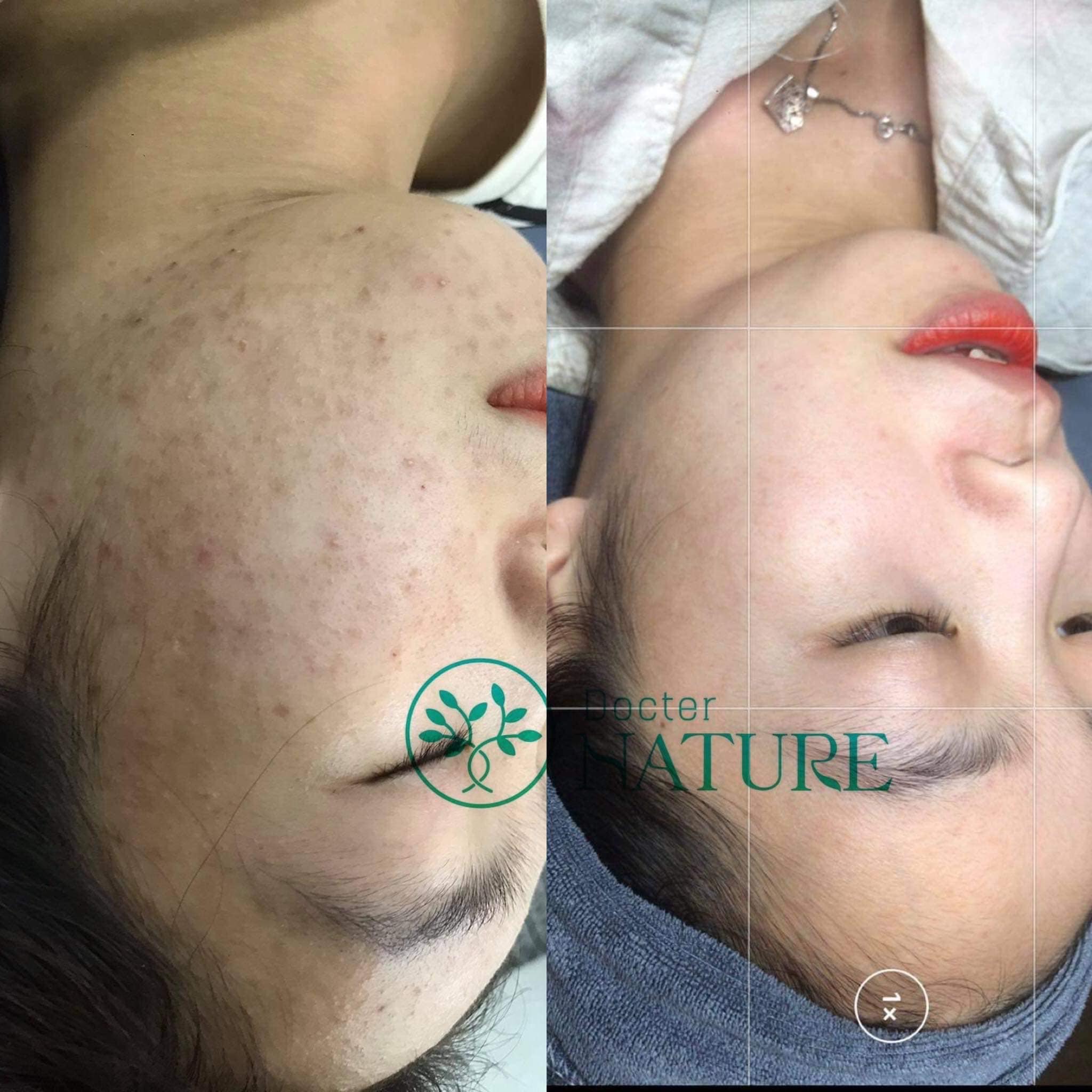 SERUM DETOX MỤN DOCTOR QUEEN -(MAU MOI)