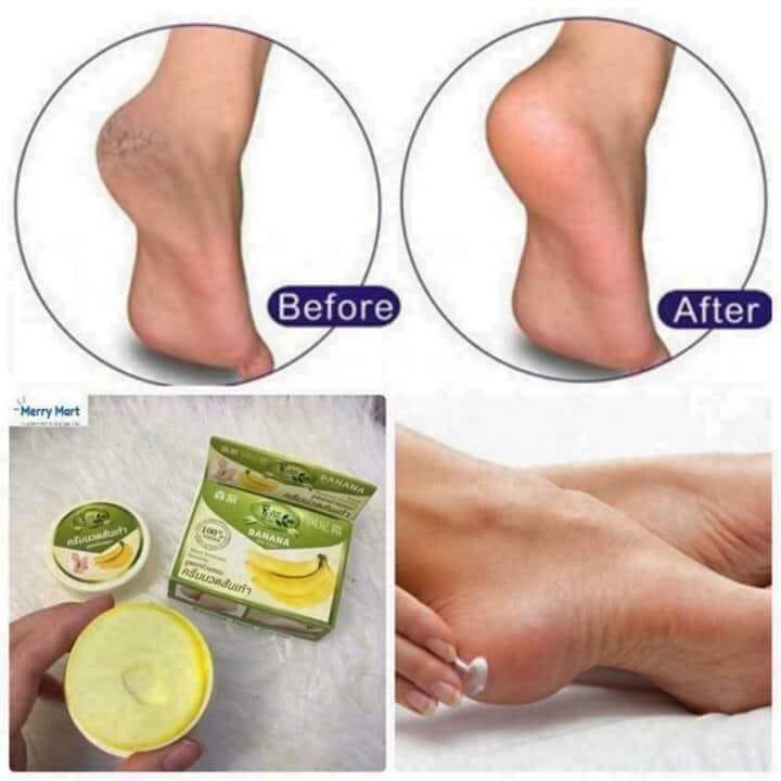 [HCM]Kem xoa nứt gót chân Thái Lan