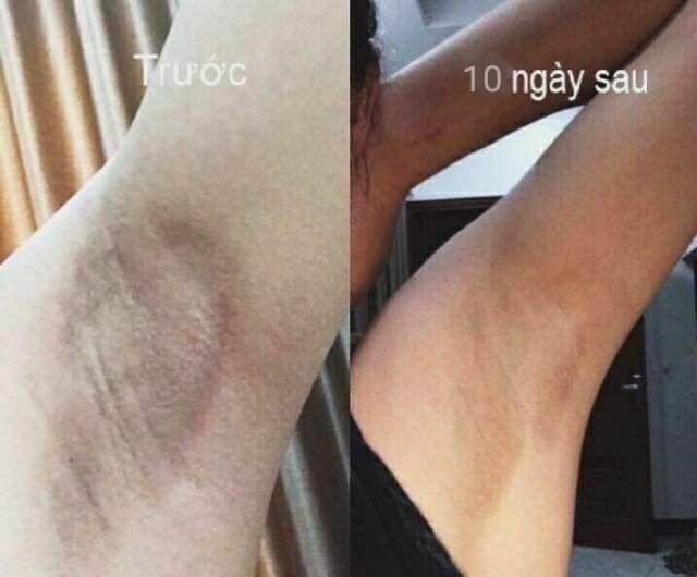 [HCM]Kem Dưỡng Trắng Nách Xóa Thâm Mịn Da DIDIE
