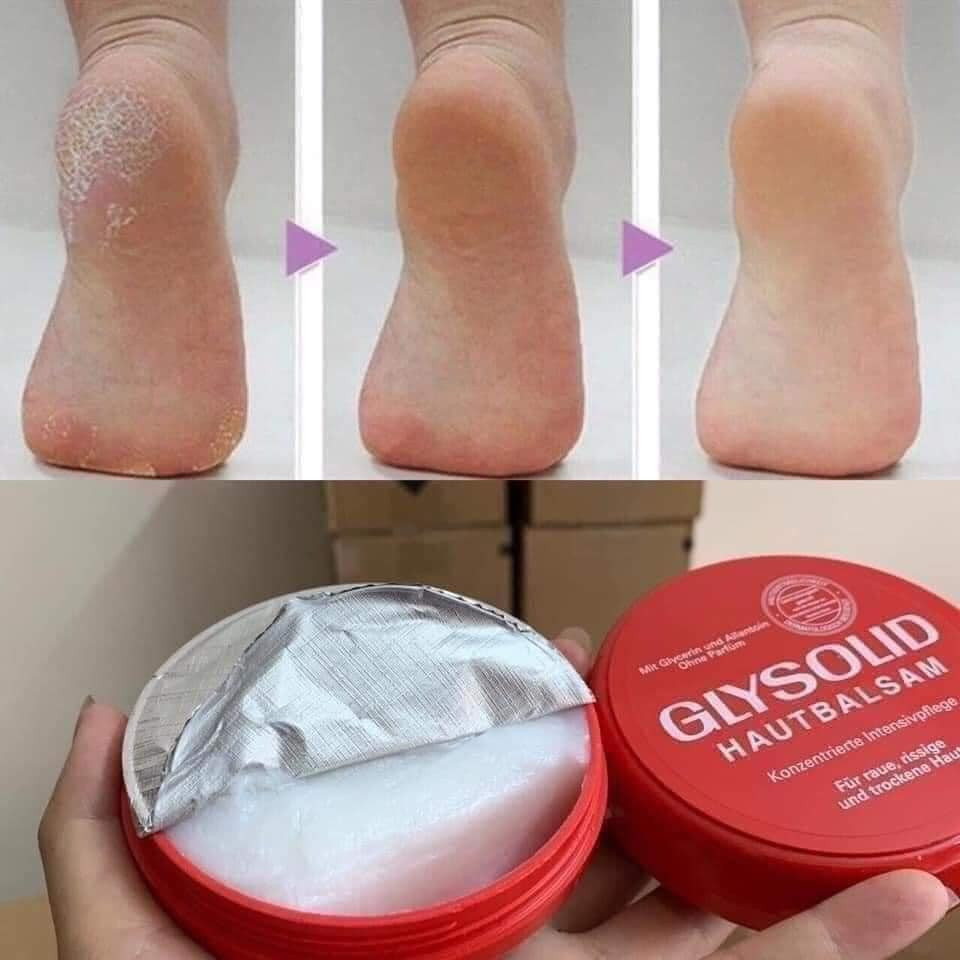Kem Dưỡng Da Glysolid Hautbalsam Đức - Cấp Ẩm, Trị Nứt Nẻ, Nứt Gót Tay Chân 100ml