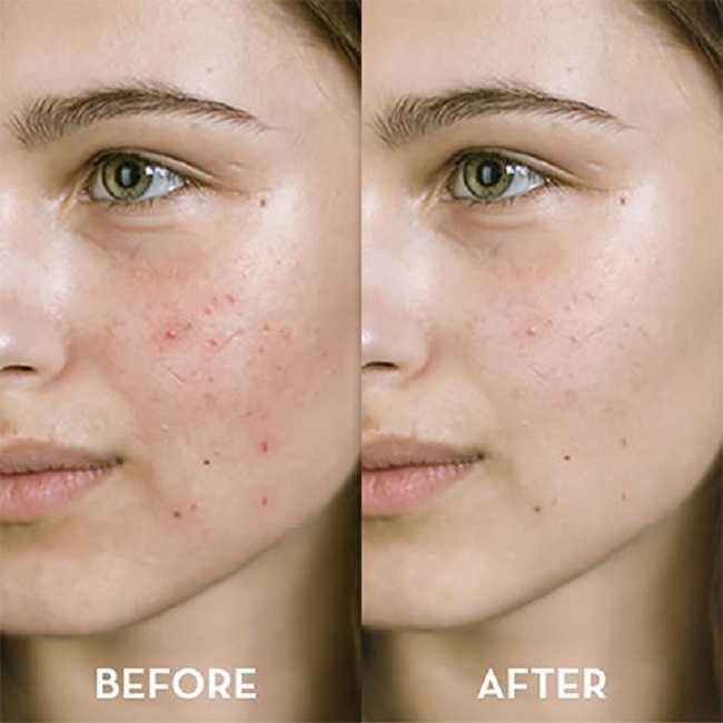Chấm Mụn Neutrogena On The Spot Acne Treatment 21g [Bill Mỹ]
