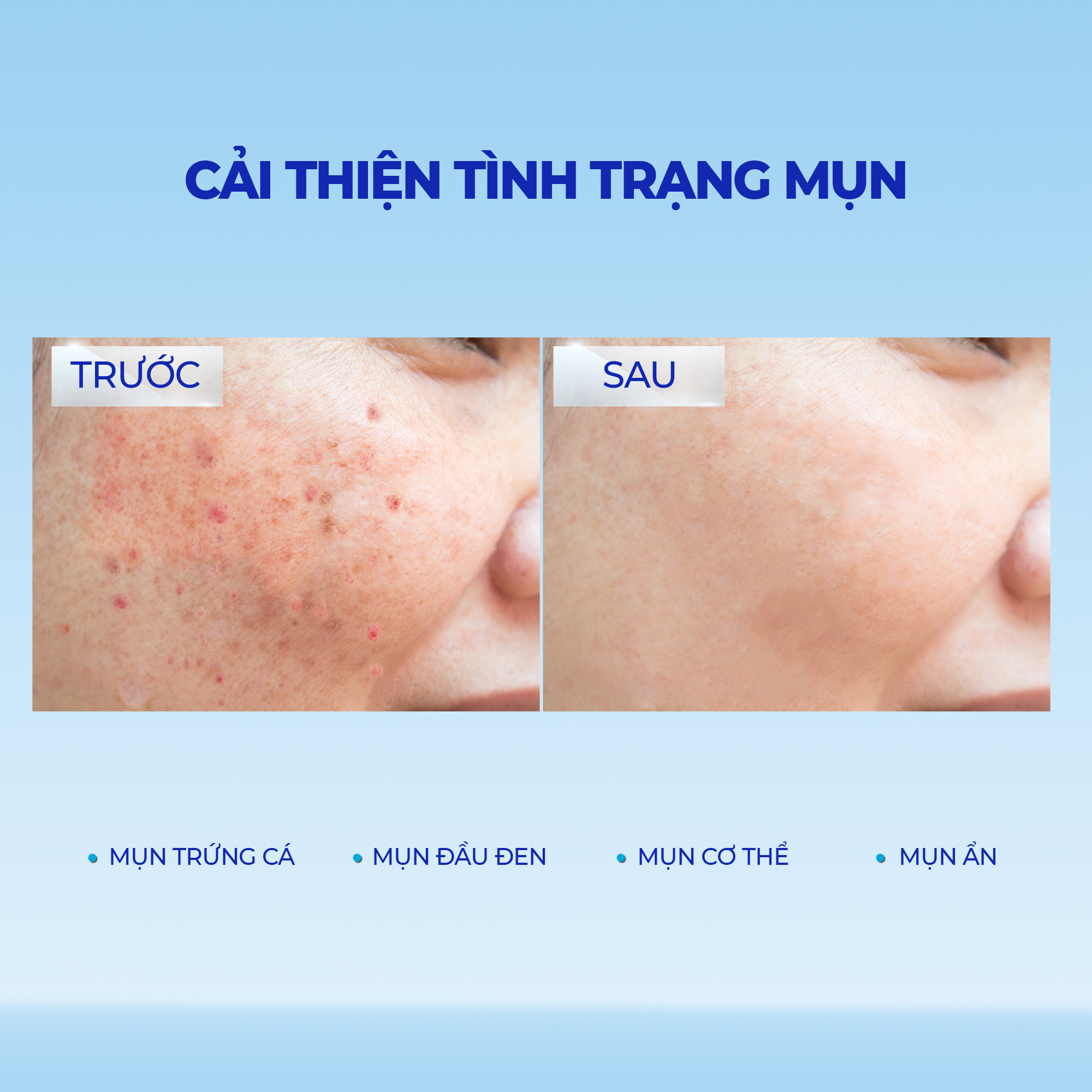 [HSD 21/03/2026] Gel Giảm Mụn Mờ Thâm Blissberry 15ml