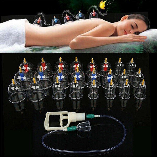 Bộ giác hơi chân không 32 cốc không dùng lửa