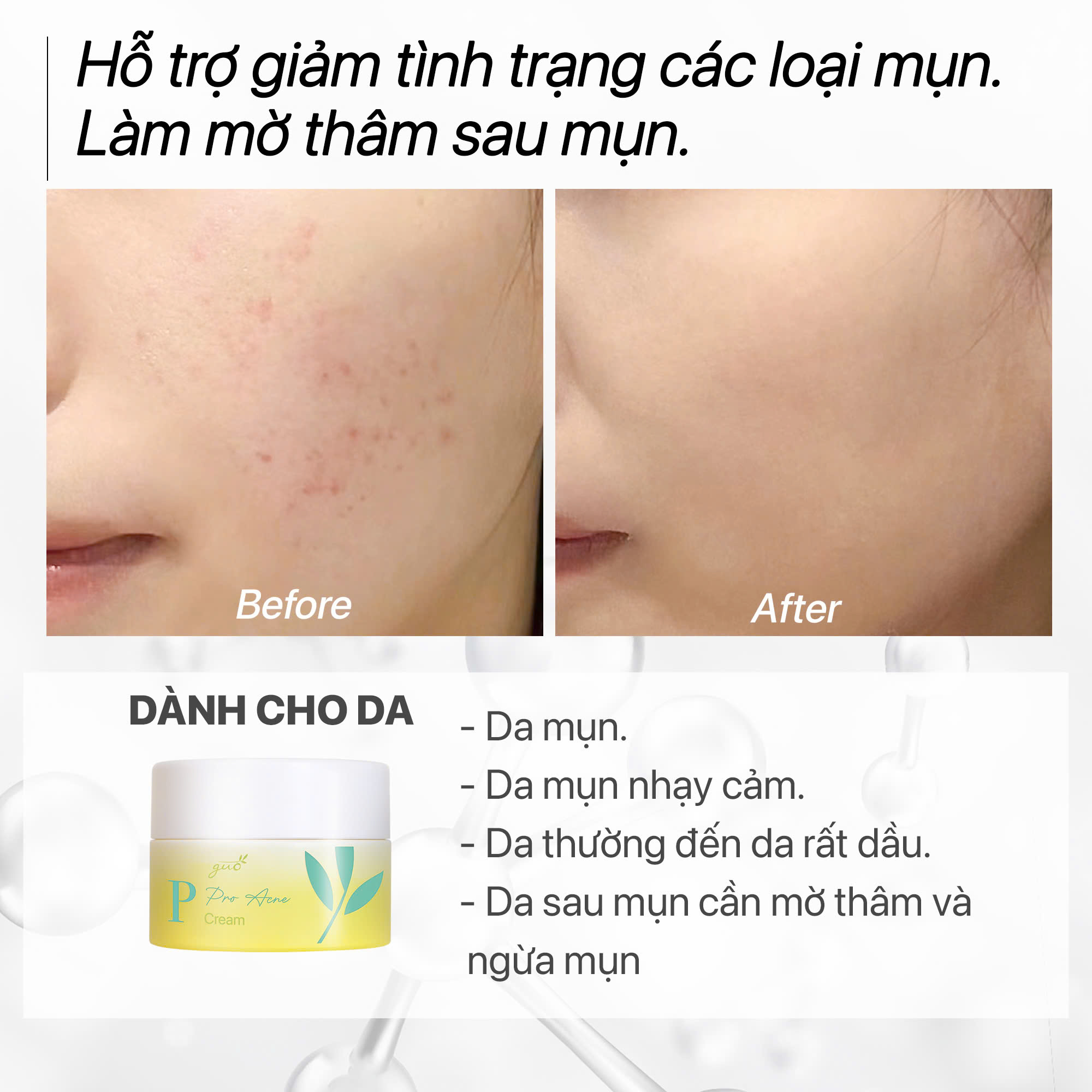 [Sạch mụn ẩn, mờ thâm mụn] Kem dưỡng da mụn trà nghệ GUO 30g