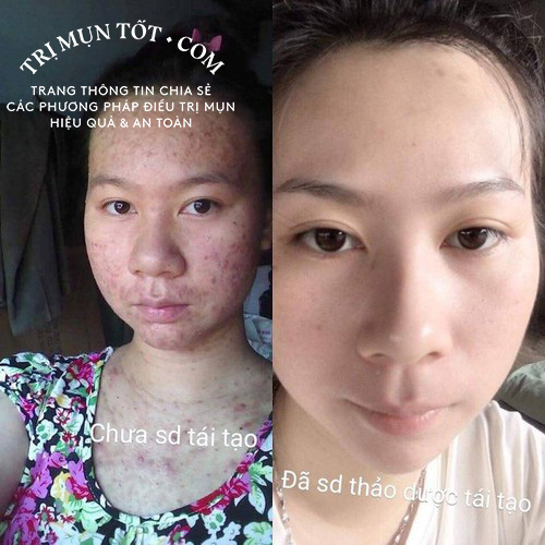 SERUM THẢO DƯỢC TÁI TẠO DA YODY (miễn ship )