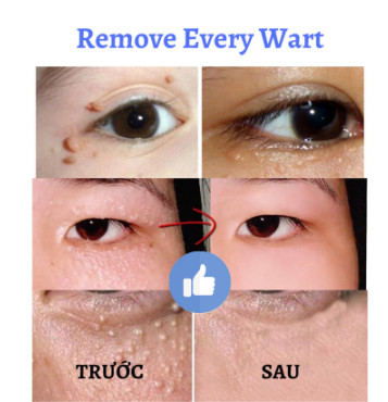 {ĐÁNH BẬT} MỤN CÓC, MỤN THỊT REMOVE EVERY WARTS