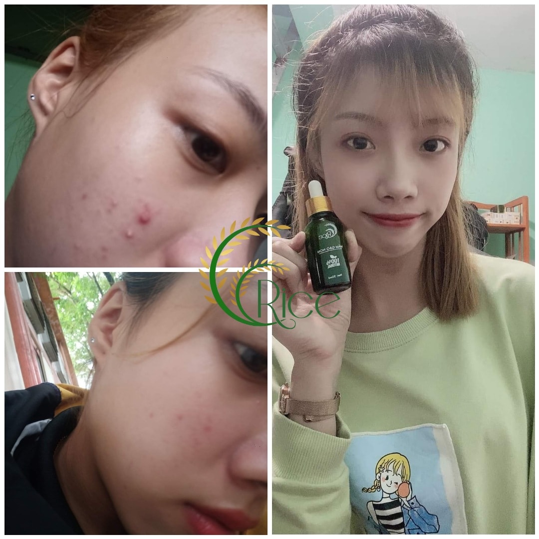 [KÈM QUÀ TẶNG] SERUM RICE MẦM GẠO NON XÓA MỤN MỜ THÂM NÁM SẠM DA