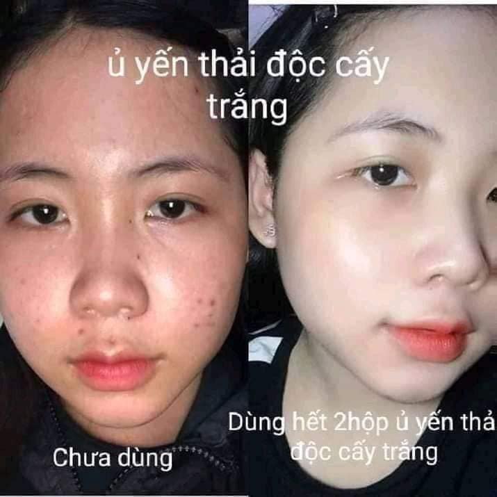 Nạ ủ yến thải độc Magic Skin