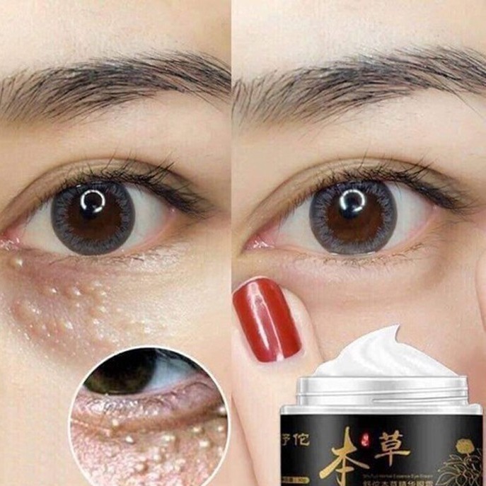 Kem mụn thịt quanh mắt,  thâm quầng mắt (cam kết chuẩn nội địa) lọ 40gr