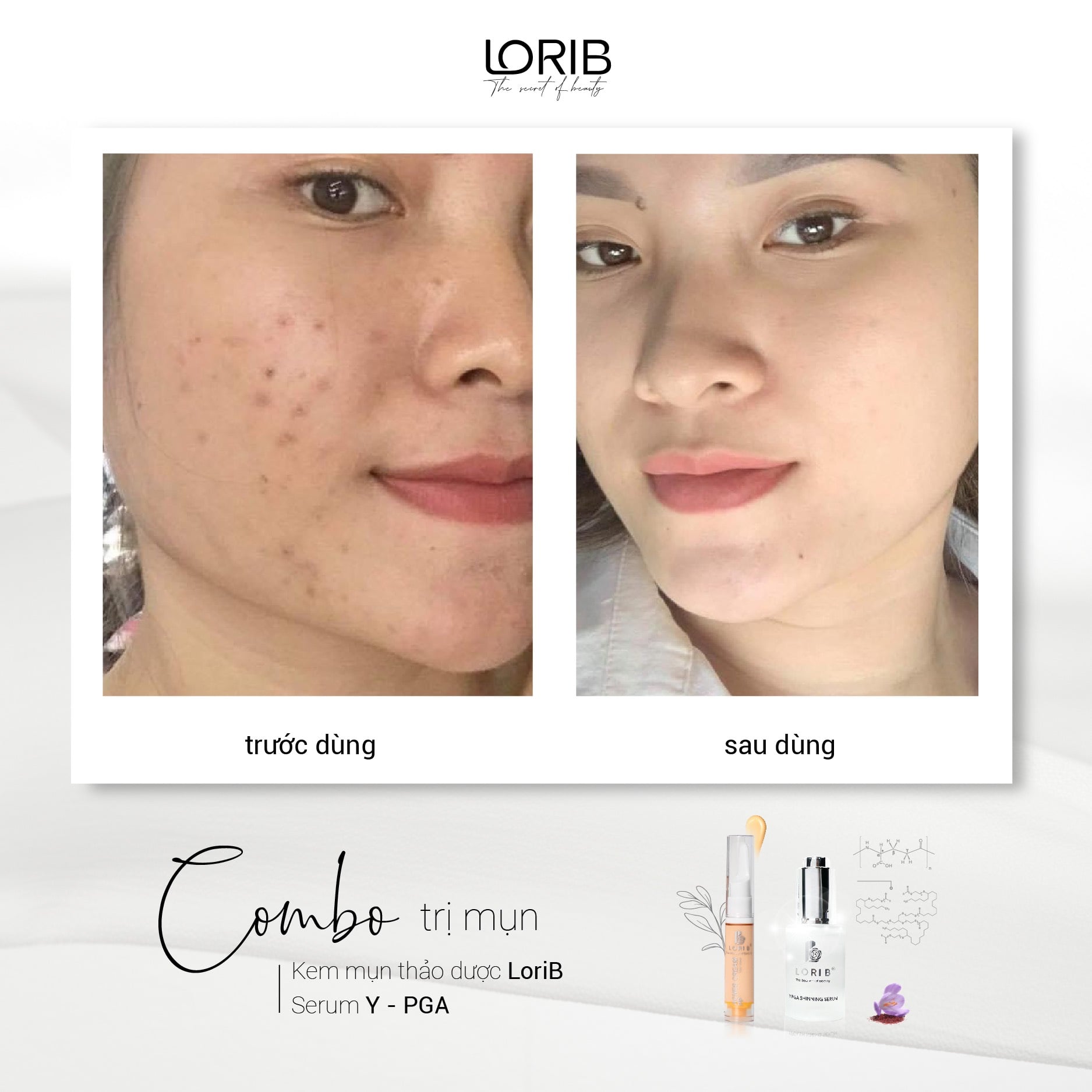 Kem mụn thảo dược Lori B - 10ml