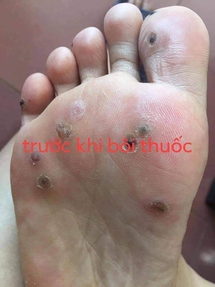Mụn cóc Mụn cơm Mắt cá Chân Tay