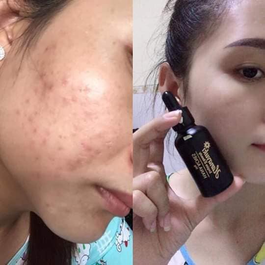 Serum Trị Mụn Hanayuki - Hana Acnes