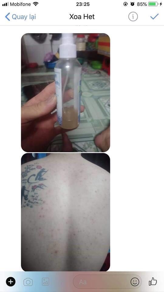 Mụn Lưng Mụn Ngực Men Vi Sinh Tavida