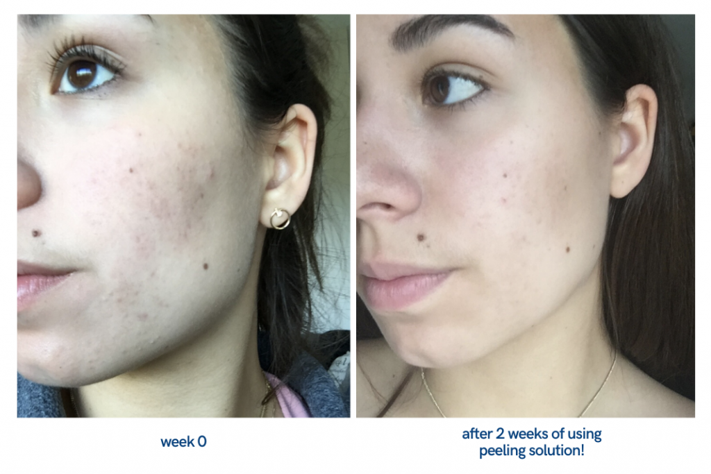 [HCM]Tinh chất The Ordinary AHA 30% + BHA 2% Peeling Solution - 30ml