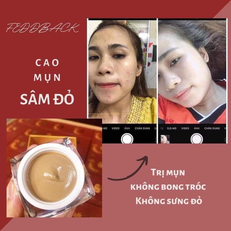 Cao Mụn Sâm Đỏ 36 Vị Đông Y Cao Cấp